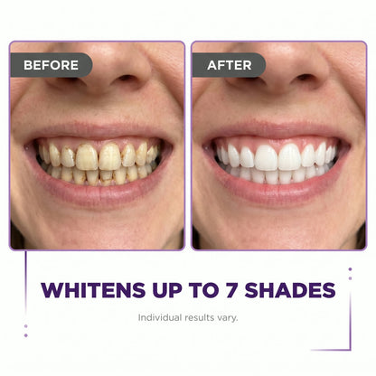 PurpleSnow Whitening Strips