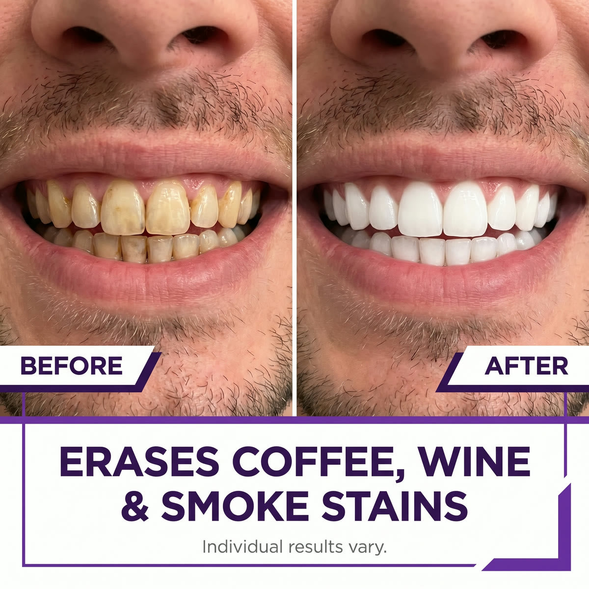 PurpleSnow Whitening Strips