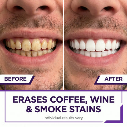 PurpleSnow Whitening Strips